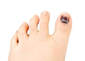 Black nail on the foot:causes,treatment and prevention