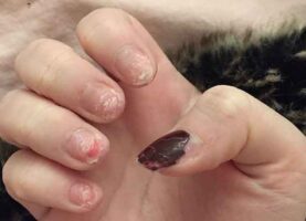 What to do when a false nail is ripped off?
