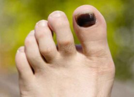 Causes of black toenails and risk factors