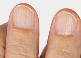 Causes of ridged nails
